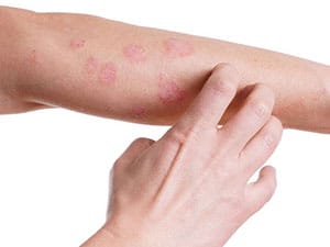 Atopic Dermatitis - Dr Sumit Gupta