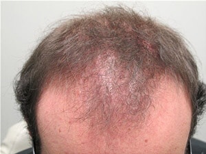 Cicatricial Alopecia