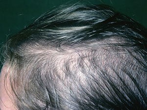 Female Pattern Baldness