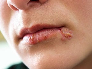 Herpes - Dr Sumit Gupta