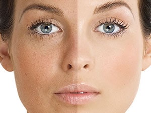 Hyperpigmentation - Dr Sumit Gupta