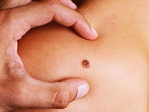 Moles occur - Dr Sumit Gupta