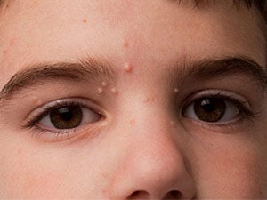 Molluscum Contagiosum - Dr Sumit Gupta