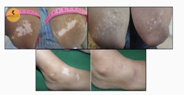 Vitiligo Treatment