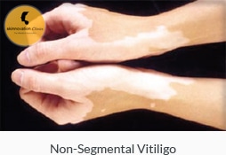 Non-segmental Vitiligo