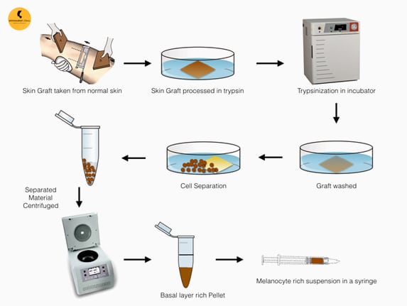 Melanocyte Transplantation