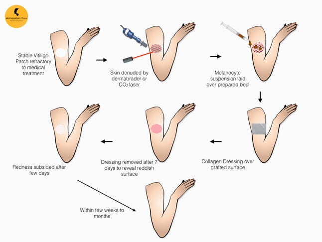 Melanocyte Transplantation