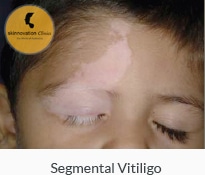 Segmental Vitiligo or Unilateral Vitiligo