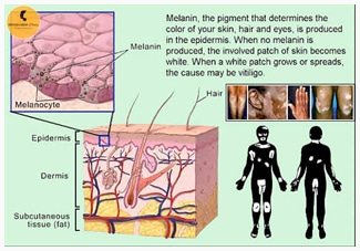 causes of Vitiligo