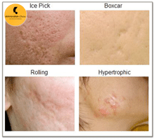 Acne-Scar Removal in Delhi