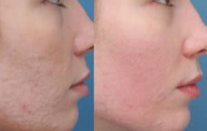 Spectra Carbon Laser Peel in Delhi