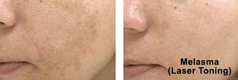 What are the remedies to Pigmentation