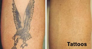 Tattoo Removal in Delhi