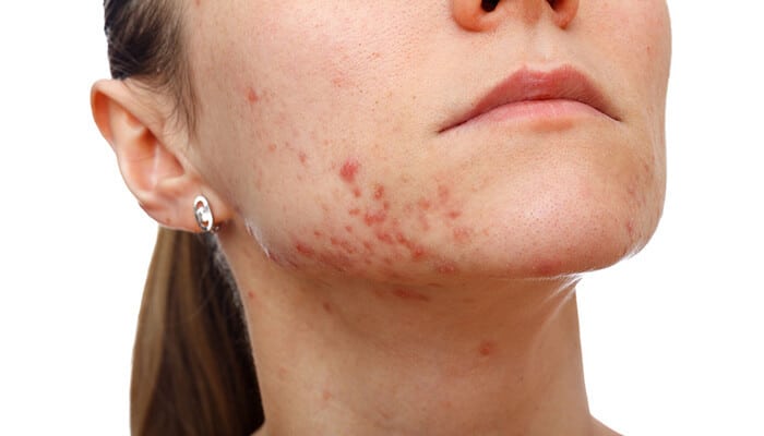 Acne Vulgaris