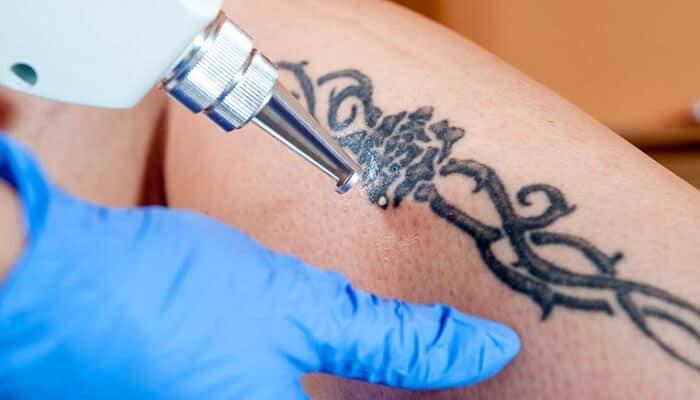 4 Reasons to Consider Laser Treatments for Removing Unwanted Tattoos -  Laser NY