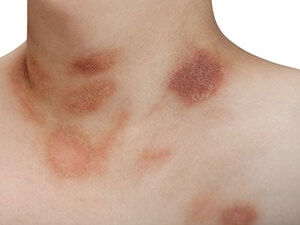 Pityriasis Versicolor - Dr Sumit Gupta