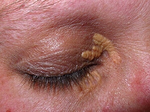 Xanthelasma - Dr Sumit Gupta